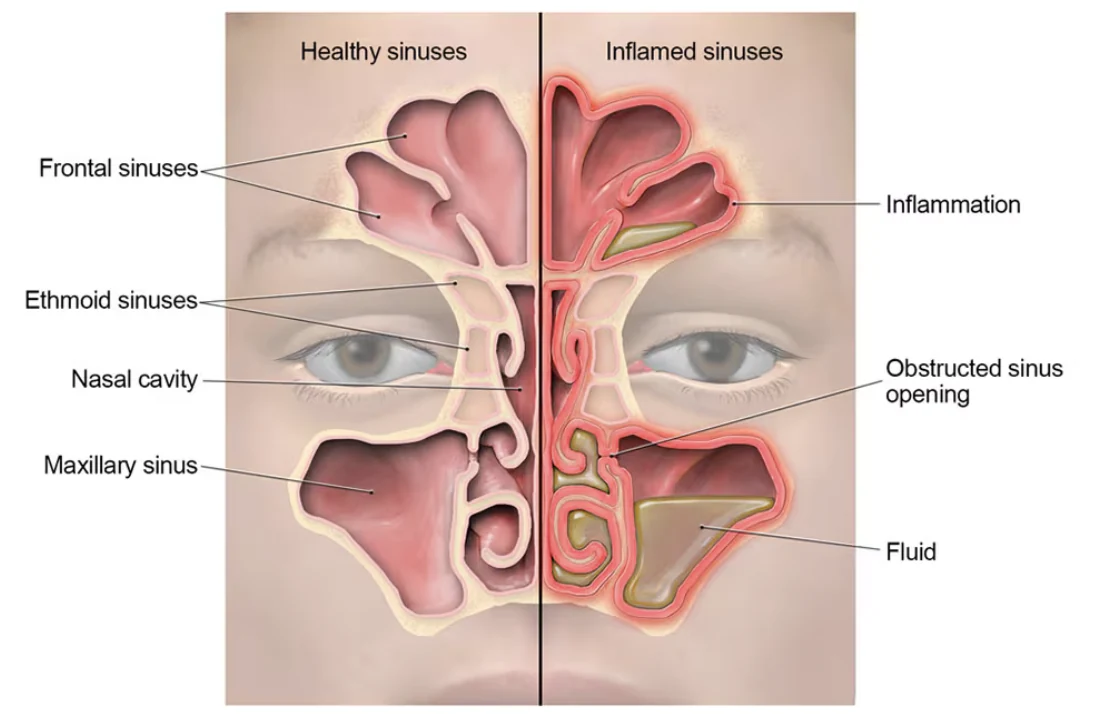Healthy and inflamed sinuses, showing fluid and narrowed openings